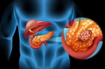 Câncer de pâncreas: causas e tratamento